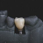 Implantes dentales en Ciudad Lineal - Atauri&Cano